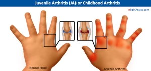 Juvenile-Arthritis